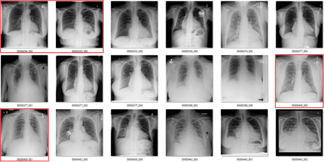 cardiomegaly labels 2