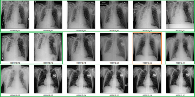 pneumothorax 1